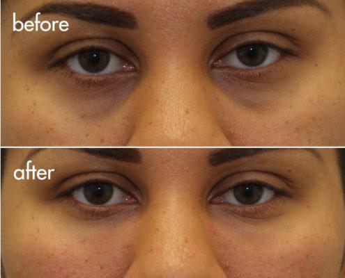 kotlus oculoplastic surgery: eye filler