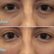 kotlus eye bags treatment: tear trough filler