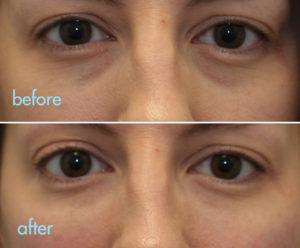 kotlus eye bags treatment: tear trough filler