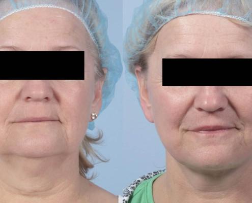 facelift with fat grafting nyc
