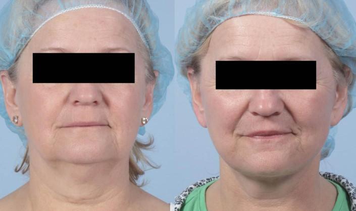 facelift with fat grafting nyc