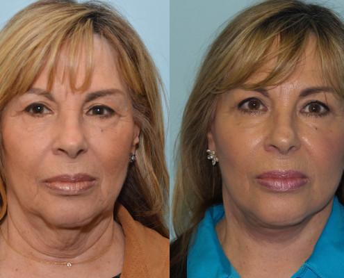 neck lift nyc fat