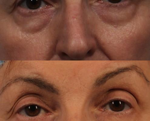 dr. brett kotlus lower eyelid surgery ny