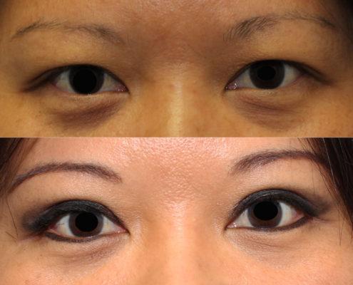 dr. brett kotlus asian double eyelid surgery