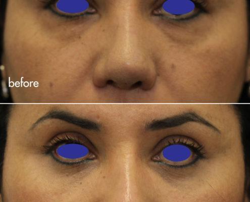 Kotlus Cosmetic Oculoplastic: lower blepharoplasty