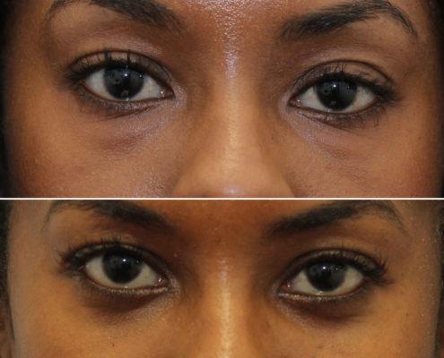kotlus oculoplastic surgery lower eyelids