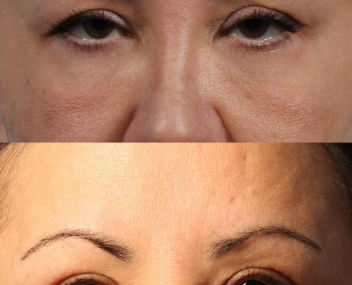 dr. brett kotlus blepharoplasty nyc