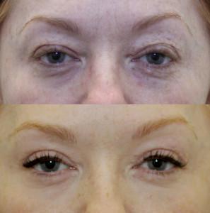 nyc upper eye lift