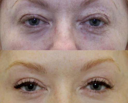 nyc upper eye lift