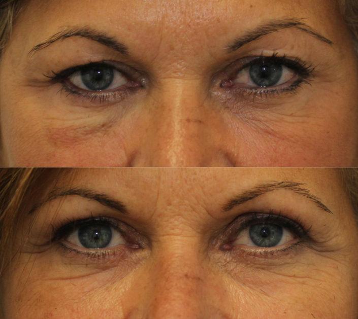 kotlus upper blepharoplasty festoons