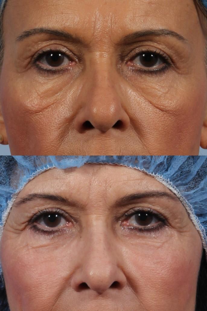 Lower Blepharoplasty Before & After Photos | Flora Levin MD