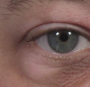 dr. brett kotlus eyelid light skin