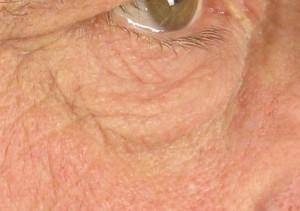 dr. brett kotlus loose skin under eye new york