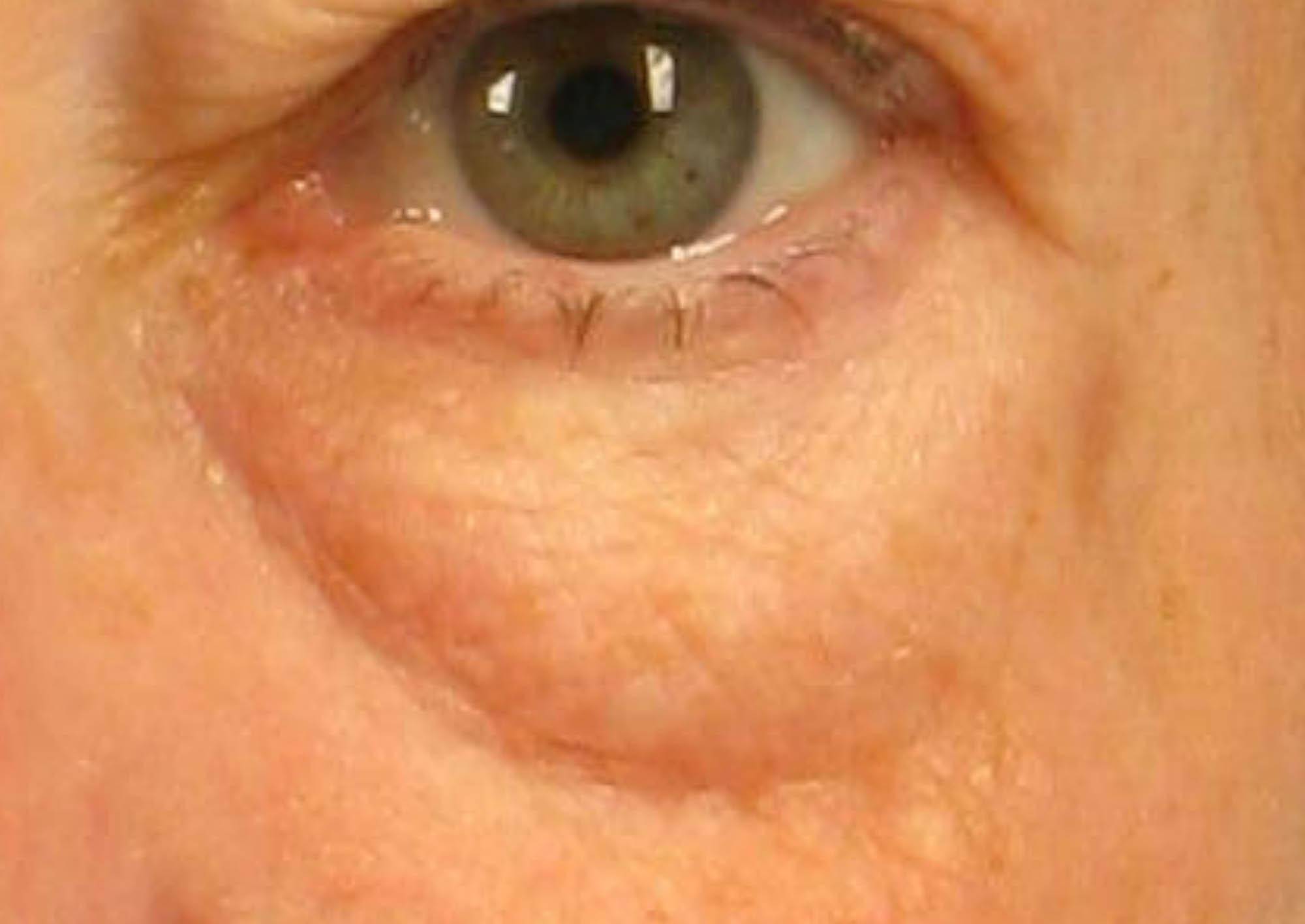 lower-eyelid-bags-dr-brett-kotlus-cosmetic-oculoplastic-surgeon-nyc