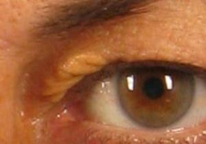 dr. brett kotlus fatty eyelid deposits ny