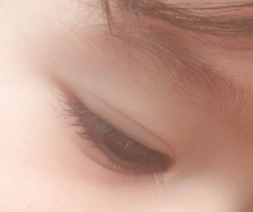 eyelid crease of youth