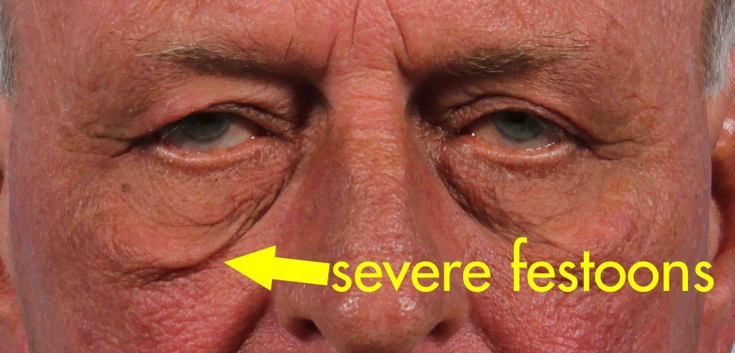 what-are-festoons-dr-brett-kotlus-cosmetic-oculoplastic-surgeon-nyc