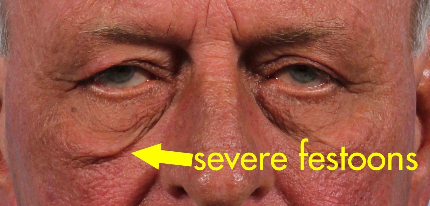 What Are Festoons? Dr. Brett Kotlus, Cosmetic Oculoplastic Surgeon, NYC