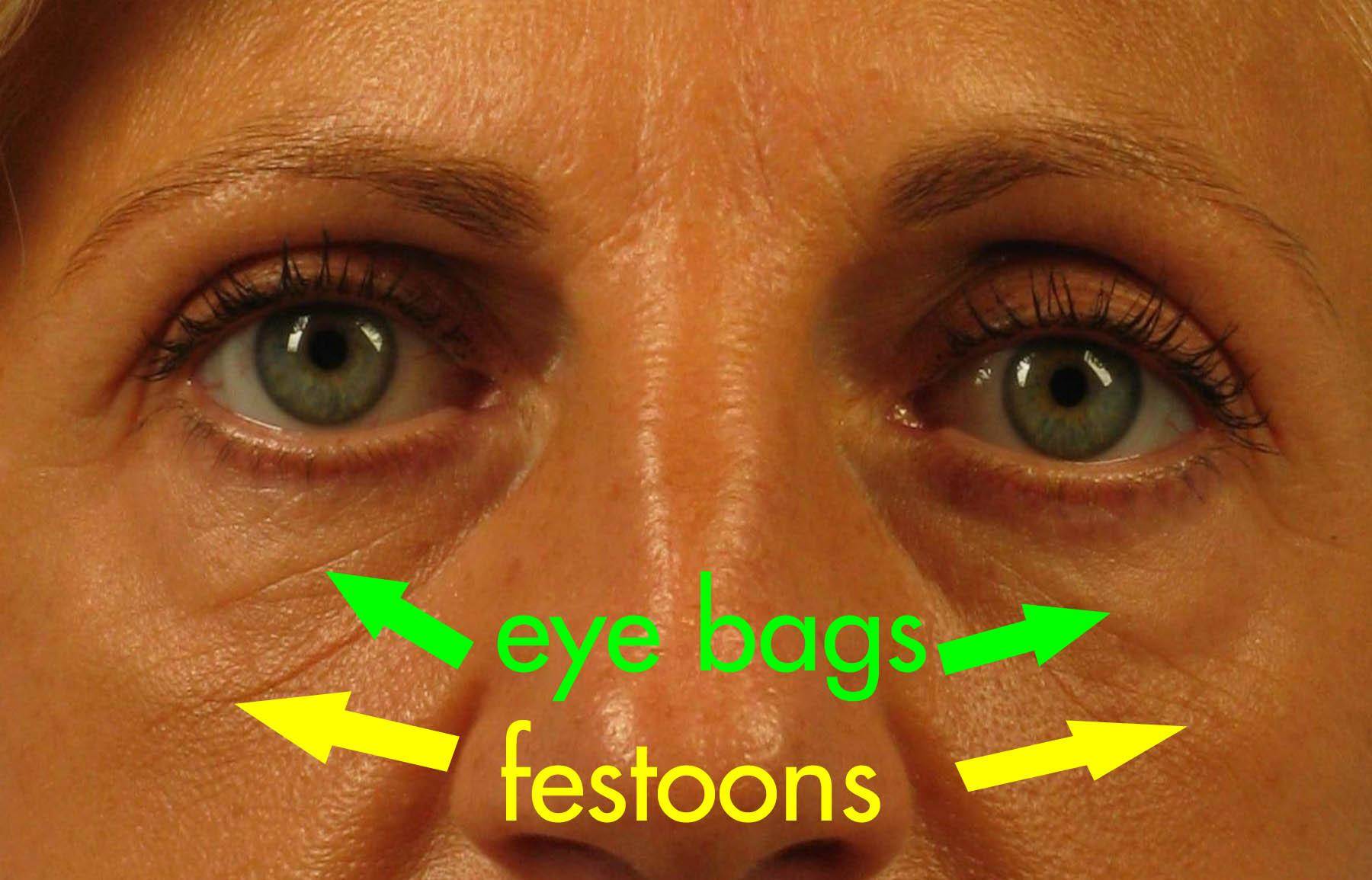 Eye Bags Can Look Worse When Treated With Filler – Here's Why