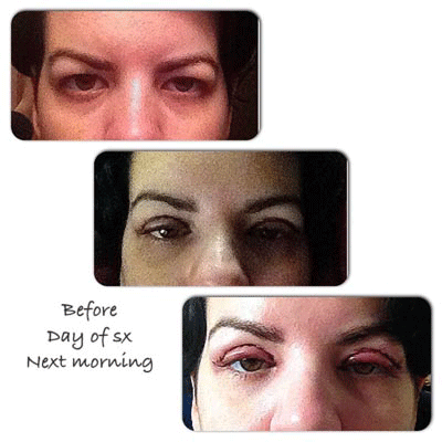 eyelid surgery recovery