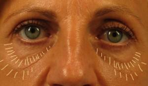 under eye fat grafting