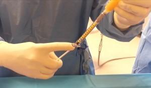 injection fat grafting