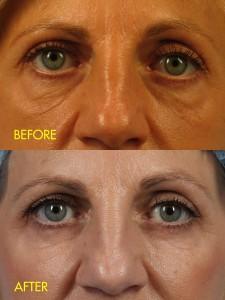 before and after under-eye fat