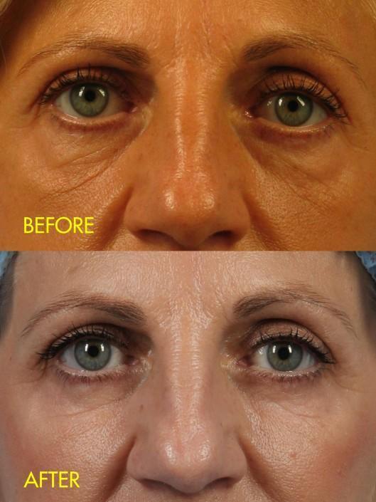 dr. brett kotlus before and after under-eye fat