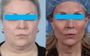 bariatric wrinkles