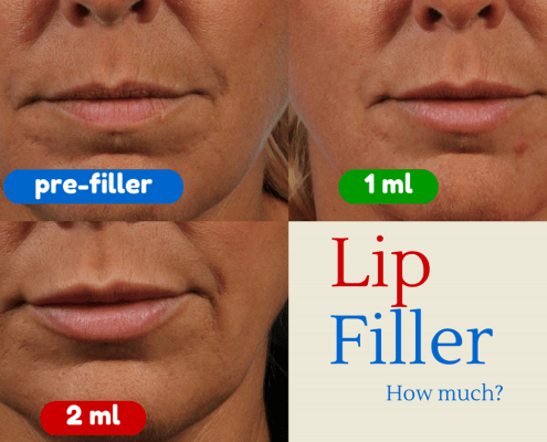 dr. brett kotlus plump lip juvederm