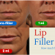 dr. brett kotlus plump lip juvederm