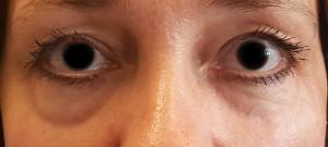 dr. brett kotlus cannula eye bags