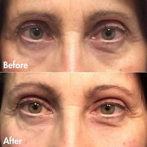 dr. brett kotlus upper eyelid restylane