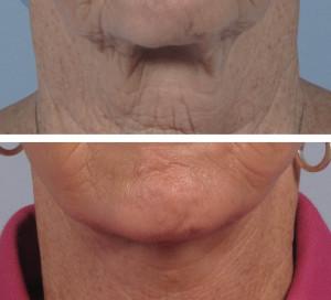 dr. brett kotlus neck lift ny