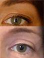 dr. brett kotlus upper blepharoplasty