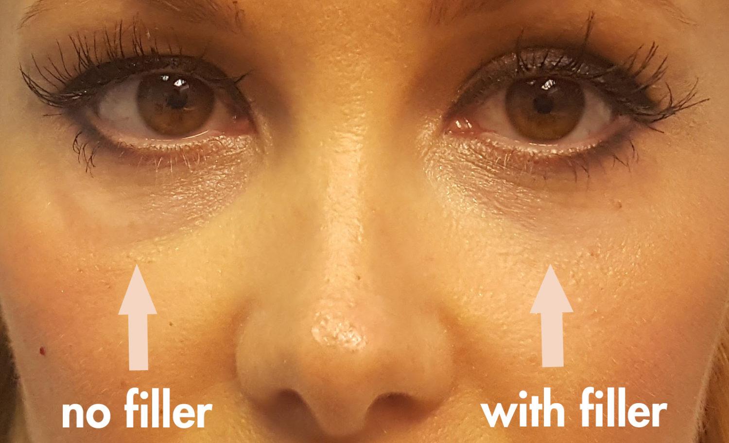 Eye Puff Injection Solution: Puffy Under Eyes After Filler Injection | Dr. Brett Kotlus ...