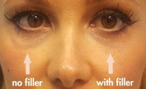 cannula eye lift