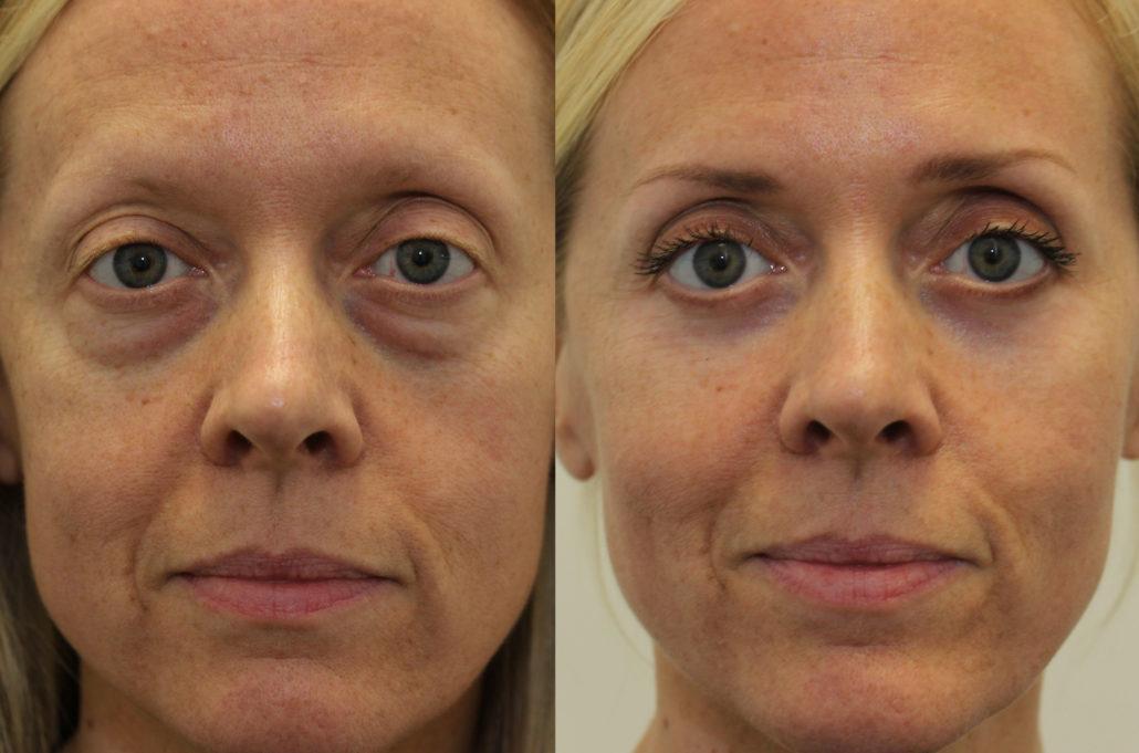 2 Plastic Surgeons on Crow's-Feet, Dark Circles, and Everything about Eyes