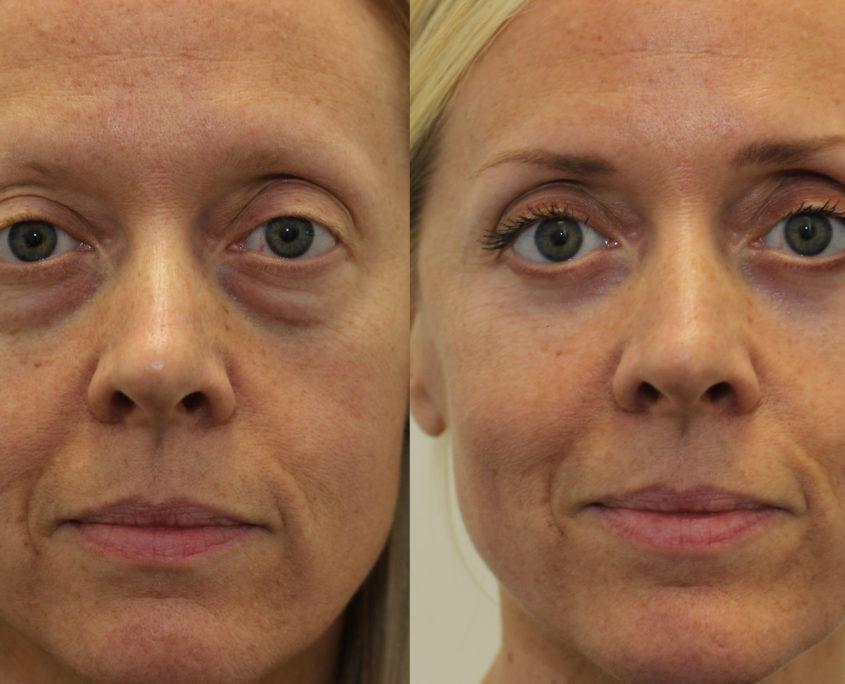 How Can I Remove My Eye Bags  London Premier Laser  Skin Clinic