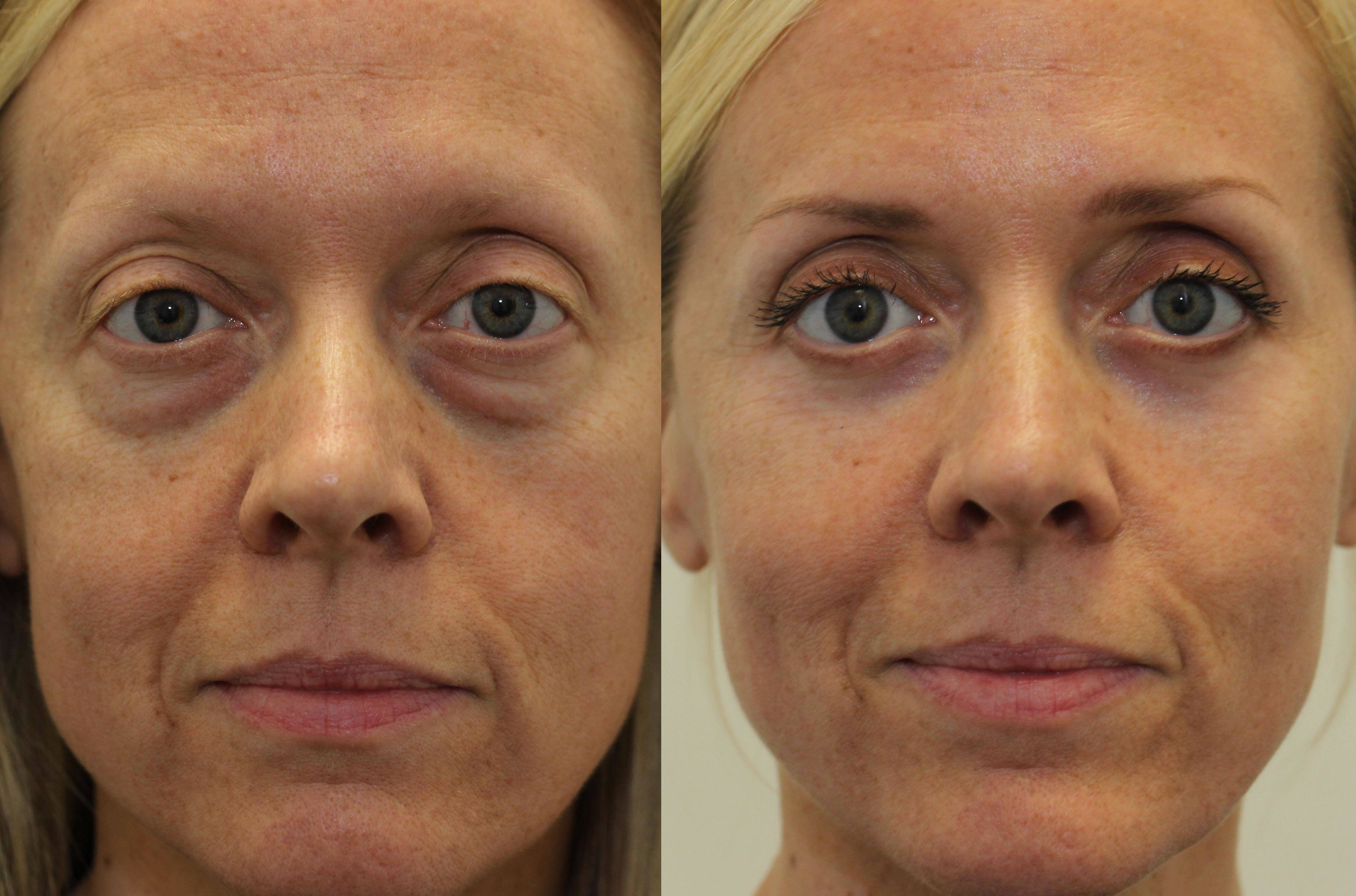 Can Under Eye Bags be Removed Without Surgery? - Ocala Eye