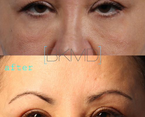 upper eyelid lift nyc