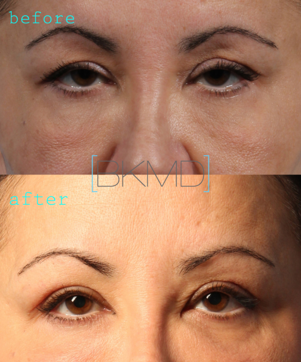 upper eyelid lift nyc