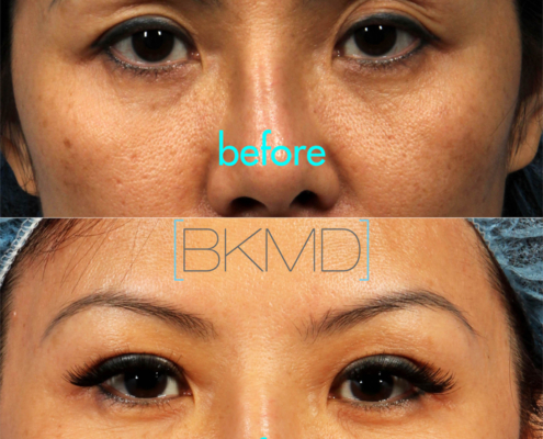 Primary Double Eyelid Fat Grafting