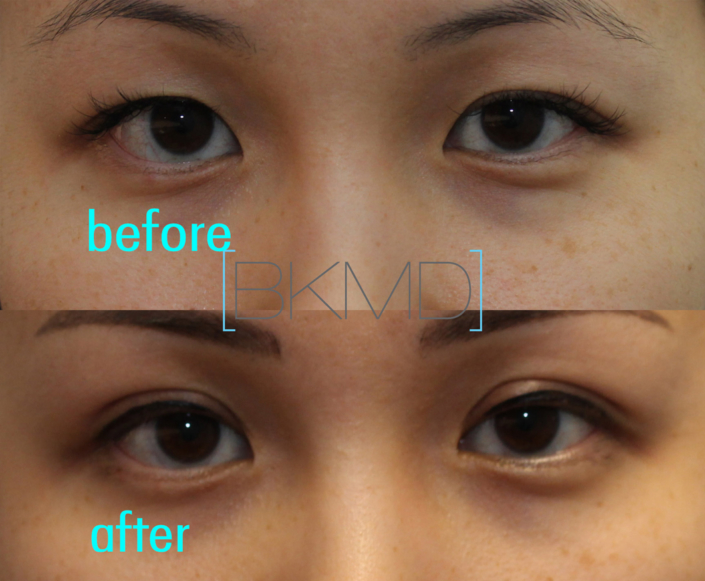 Primary Double Eyelid Surgery