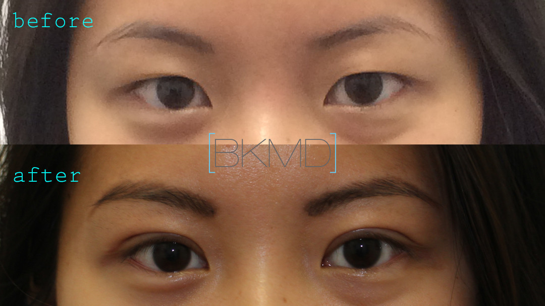 Asian Double Eyelid Photos Dr. Brett Kotlus