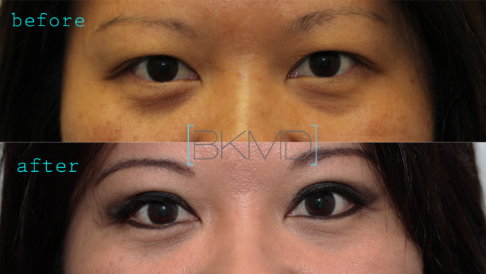 Primary Double Eyelid Surgery