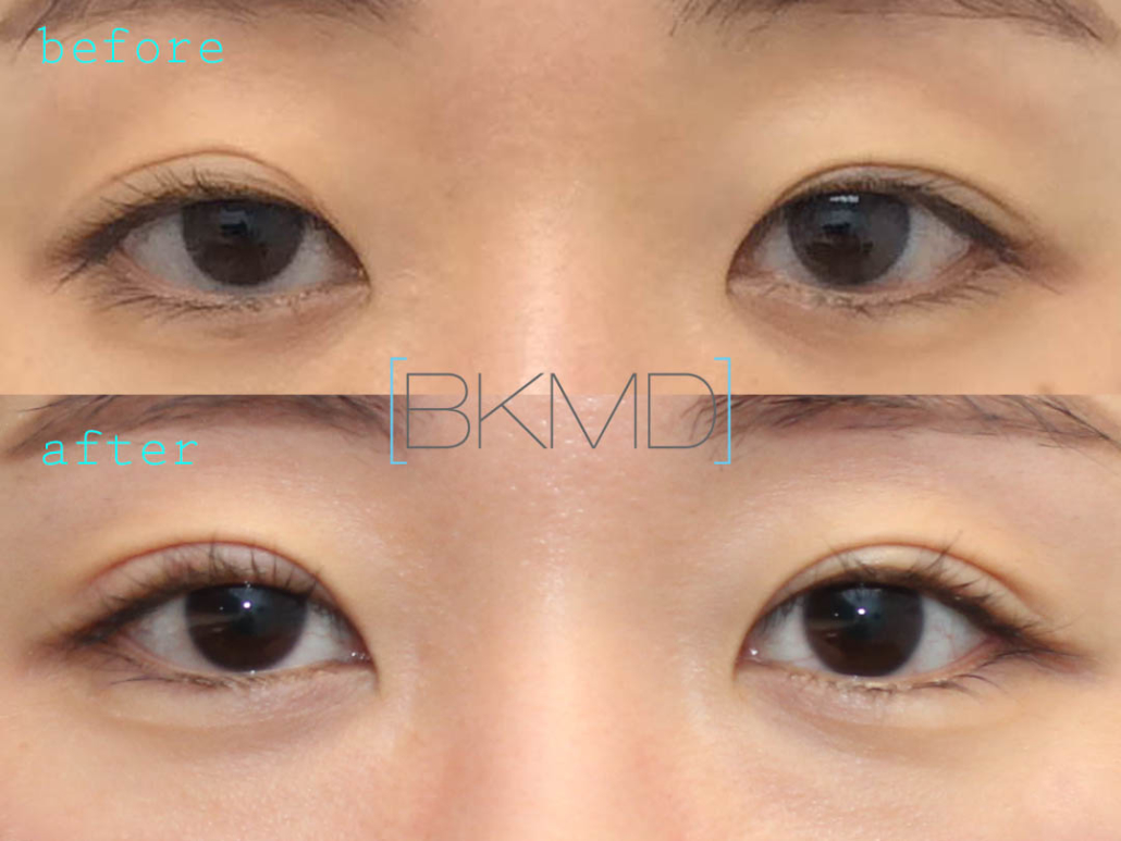 Double Eyelid Tape and Glue  Dr. Brett Kotlus, Cosmetic Oculoplastic  Surgeon, NYC