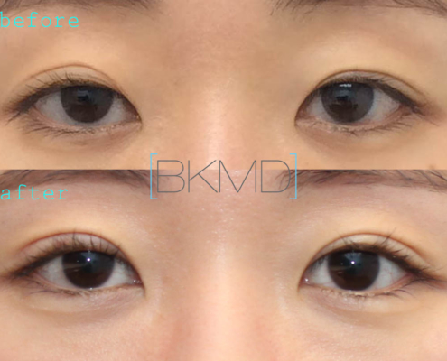 Revision Double Eyelid Ptosis Repair