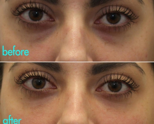 Remove under-eye bags with a Cannula bag lift by Dr. Kotlus