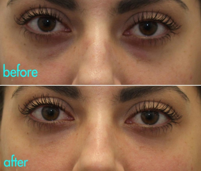 Remove under-eye bags with a Cannula bag lift by Dr. Kotlus